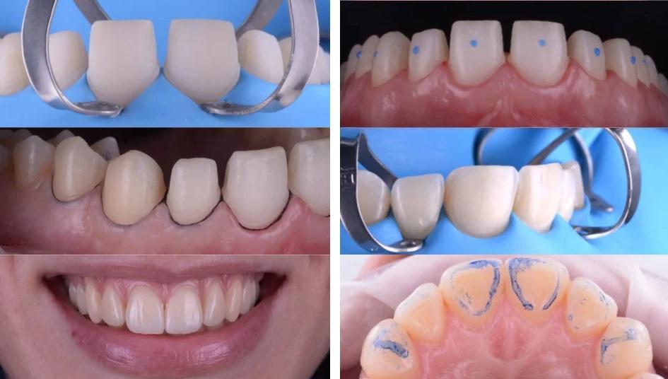 ADHESION – Full Ceramic Restorations