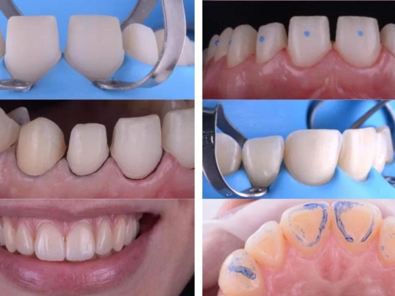 ADHESION – Full Ceramic Restorations
